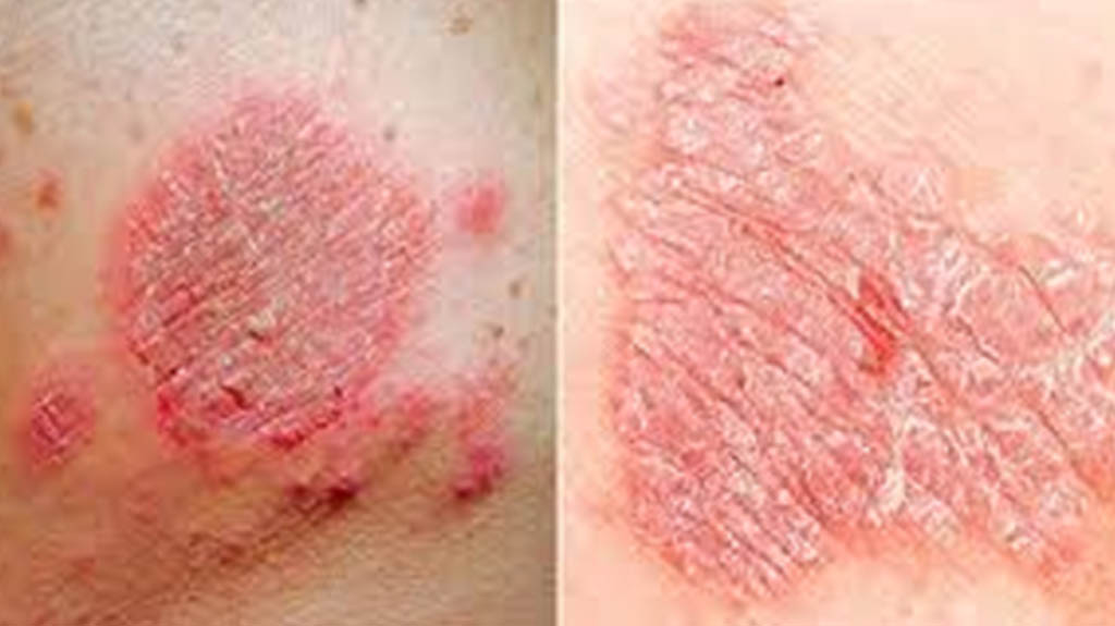 Eczema and Dermatitis