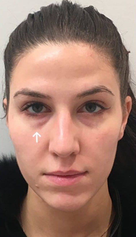 dark circles before image