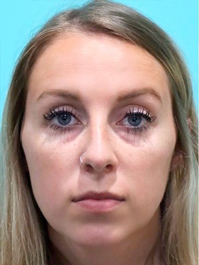 Tear through treatment before