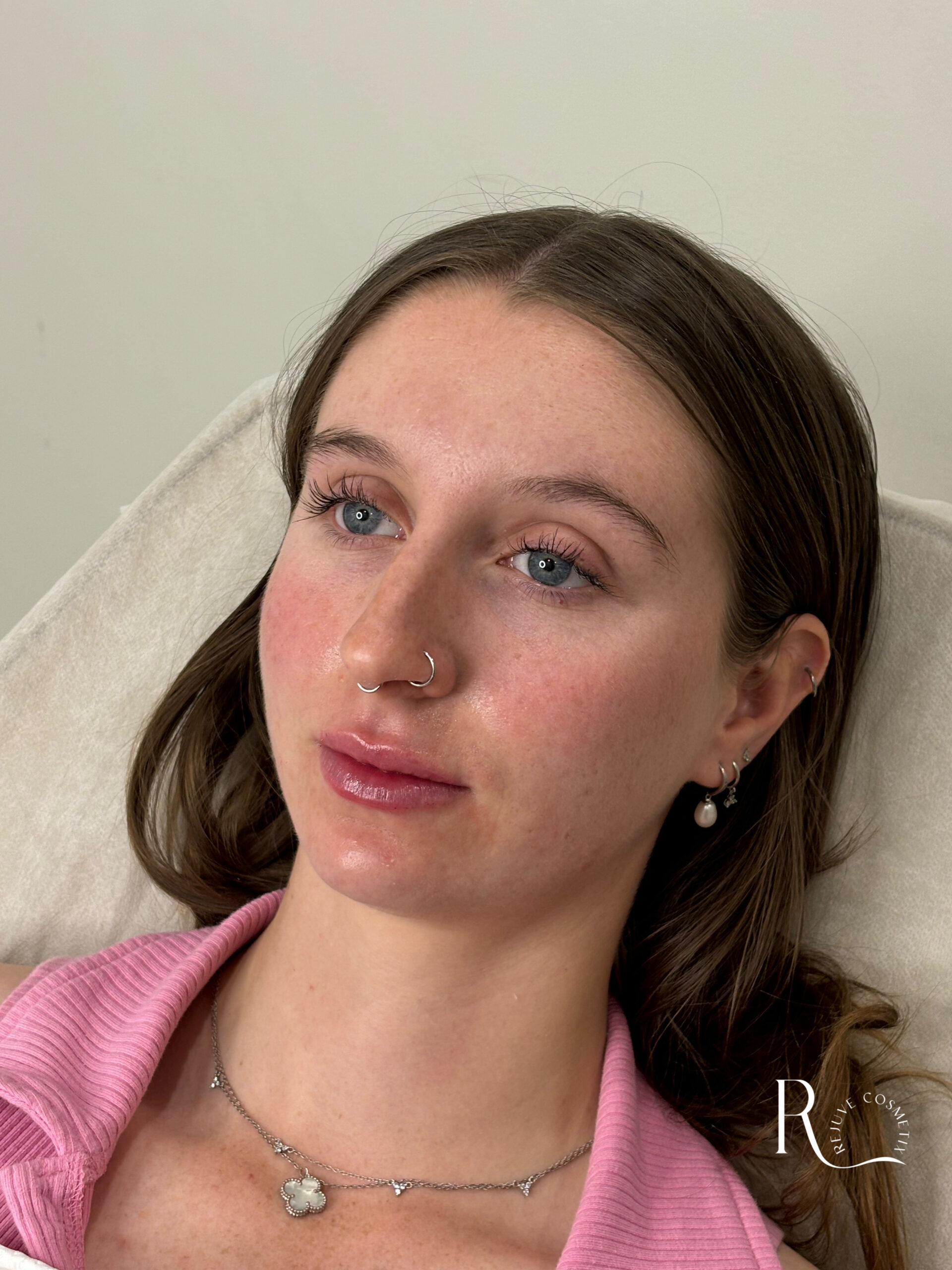 Lip filler